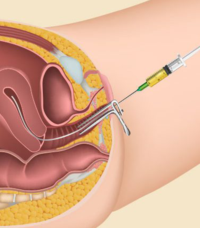 inseminacao